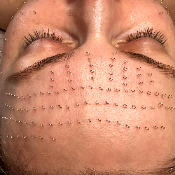 estetyczne pinezkowanie twarzy Wrocław