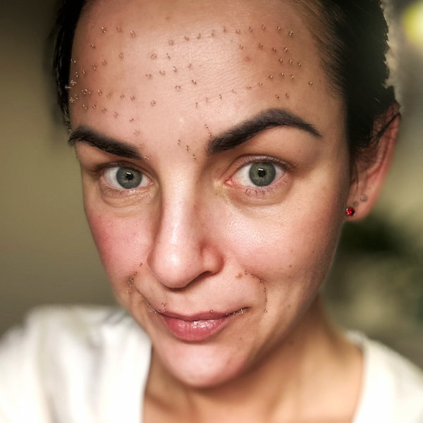 pinezkowanie twarzy Wrocław